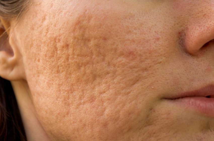Is it possible to cure the holes and marks caused by pimples?