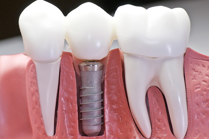 What are the best dental implant materials?
