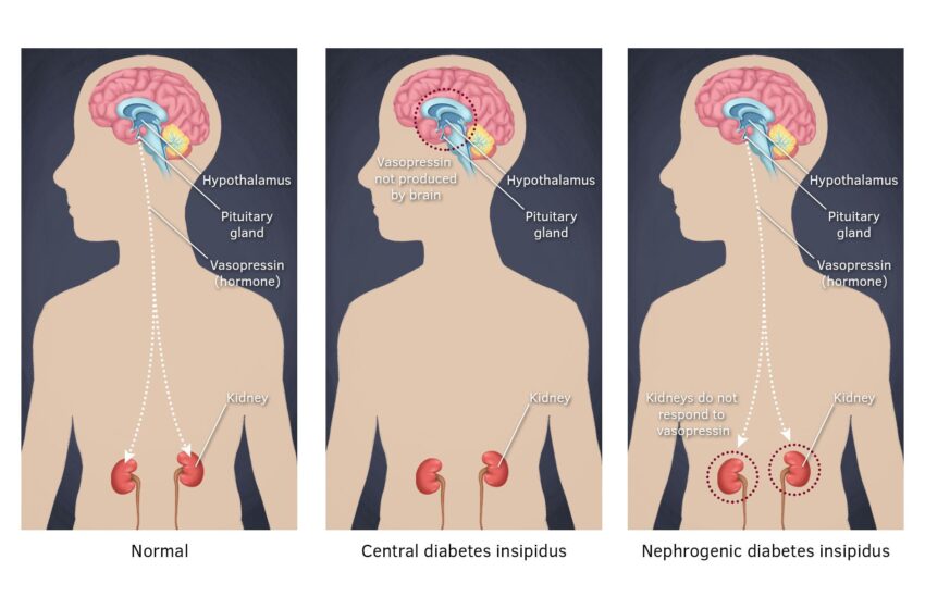  What is diabetes insipidus?